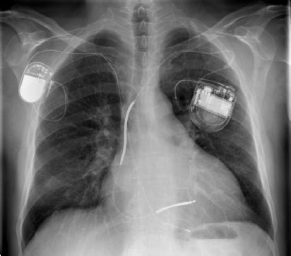 It involves the analysis of both the leads and the crmd can. Chest x-ray PA. Male patient, VVIR-pacemaker on the right ...