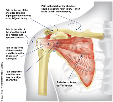 Shoulder Pain Causes And Conditions Hss Sports Medicine
