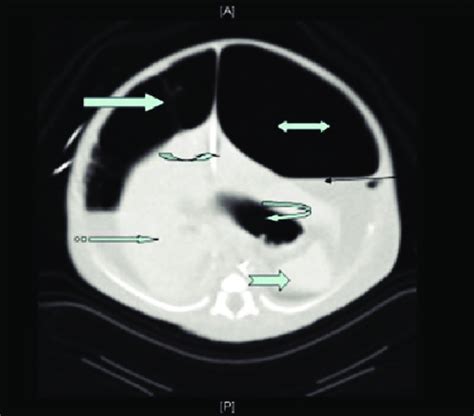 Abdominal Ct Scan Image Showing Abundant Intraperitoneal Space