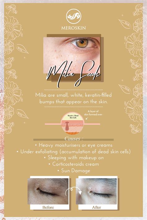 Milia Seeds On Your Face Weve Got Solution At Meroskin