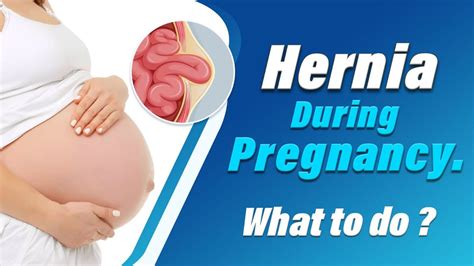 Hernia During Pregnancy Hernia Complications In Pregnancy What To Do Dr Parthasarathy