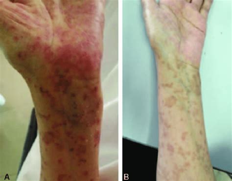 The prognosis is generally poor. Rashes on the patient with angioimmunoblastic T-cell ...