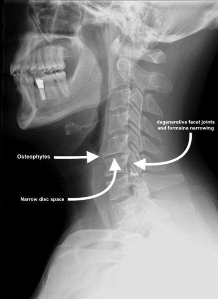 Facet Joint Syndrome Physiopedia