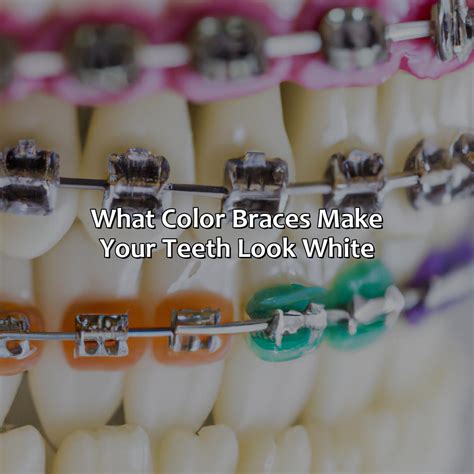 What Color Braces Make Your Teeth Look White