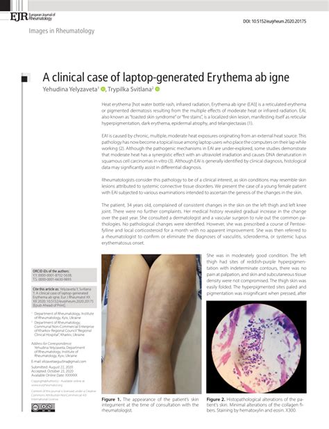 Pdf A Clinical Case Of Laptop Generated Erythema Ab Igne