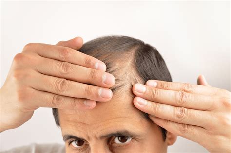 Causes Of Excessive Hair Loss Hair Loss Topic