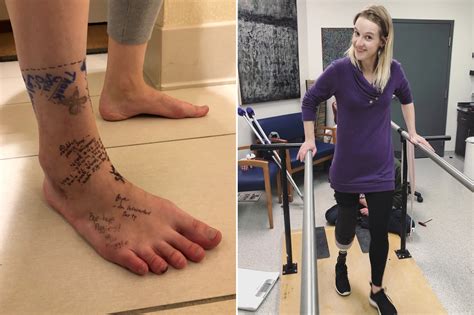 Woman Writes ‘break Up Note On Foot Before Amputation