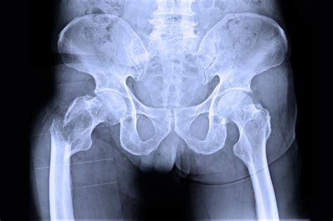 White on an xray is from something that blocks the xrays from going through, so that spot has to be hard and calcified. Decreased Osteoporosis Treatment Initiation Observed After ...