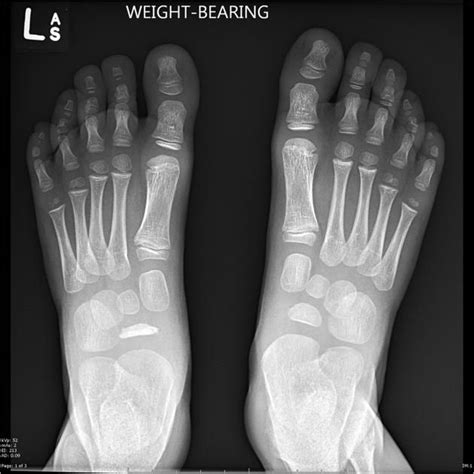 Kohler Disease Radiology Case Radiology