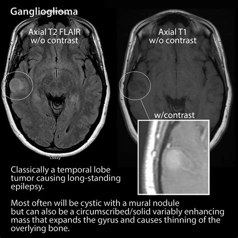 Pathology Glossary Ganglioglioma And Gangliocytoma Draw It To Know It