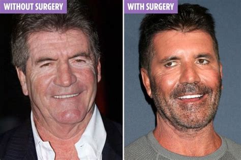 Simon Cowells ‘real Face Without Botox And Plastic Surgery Revealed