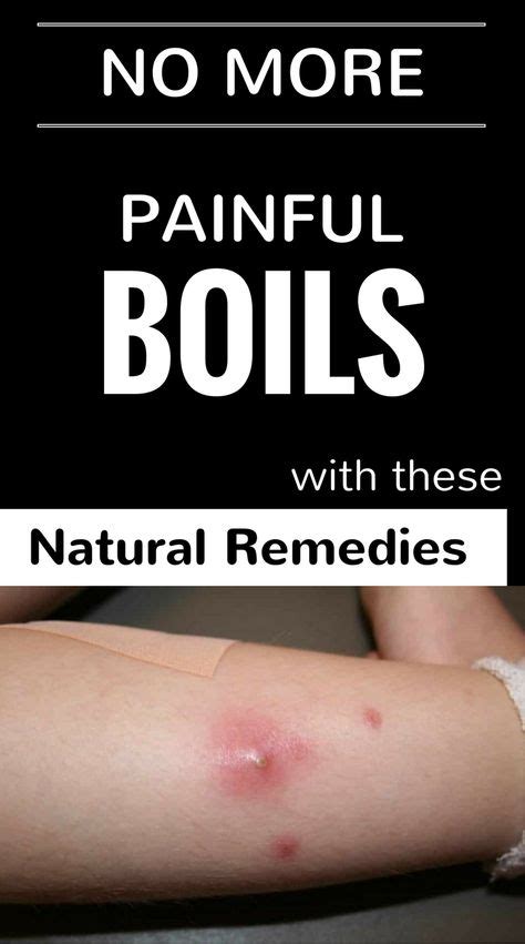 10 Best X For Boils Ideas Home Remedy For Boils Natural Remedies