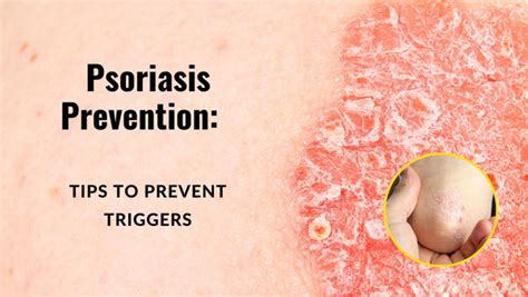 Psoriasis Prevention Tips To Prevent Triggers Hanna Sillitoe
