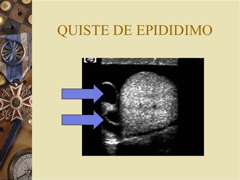 Patología Testicular