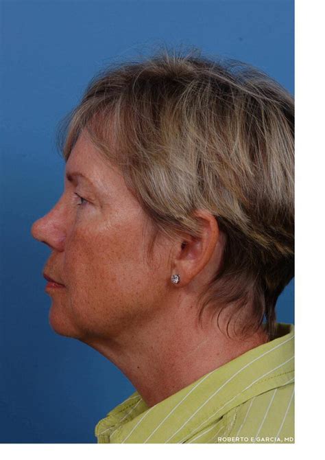Neck Lift Before And After 68 Contoura Facial Plastic Surgery