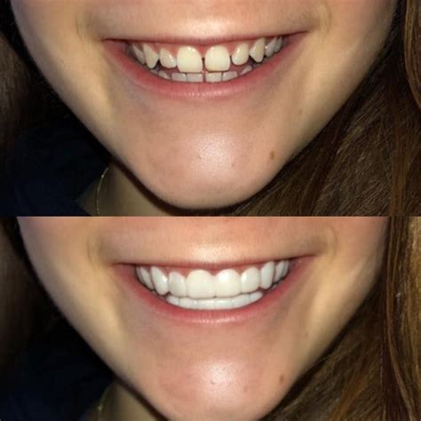 Non Surgical Veneers Are The Perfect Way To Achieve A Hollywood Smile