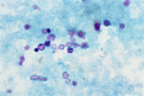 Meningeal Cryptococcosis CSF Pap Stain A Photo On Flickriver