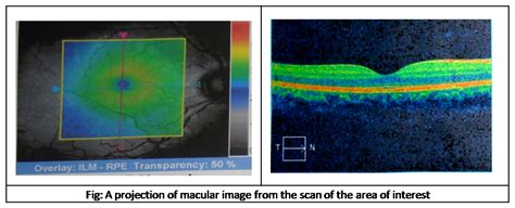 What Is Optical Coherence Tomography Oct Basic Interpretation