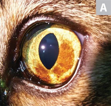 Iris melanosis is classified as benign, but in time, it may progress to a malignant melanoma. Iris Freckles, Nevi, & Melanosis in 2020 | Freckles, Laser ...