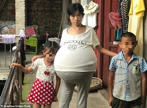 Chinese Woman S Belly Grows To Lbs Due To Mystery Condition Daily
