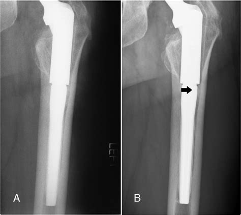 Patterns Of Osseointegration And Remodeling In Femoral Revision With