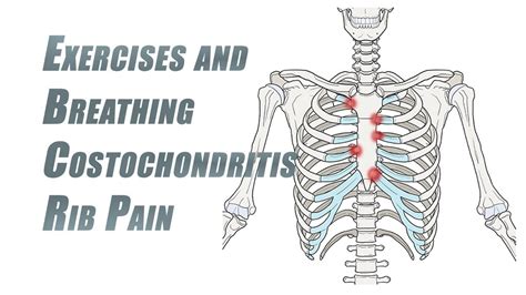 Exercises And Breathing Tips For Rib Pain Costochondritis Youtube