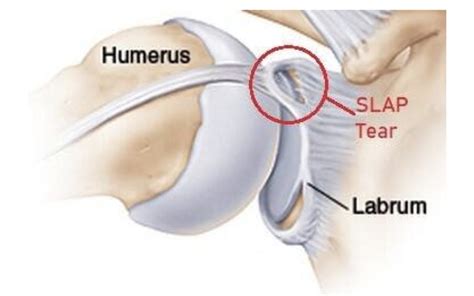 Superior Labrum Anterior To Posterior Lesions Of The Shoulder My Xxx