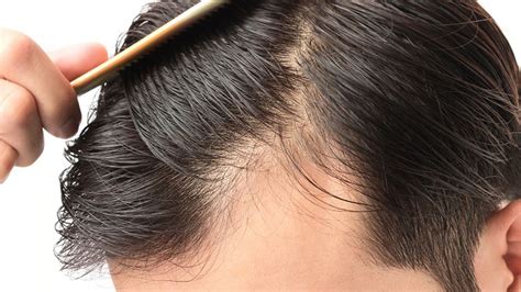 B vitamins are good for hair growth, especially biotin. Finasteride vs. Minoxidil: Which men's hair loss treatment ...