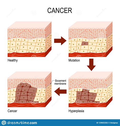 Cancer And Normal Cells Comparison And Difference Vector Illustration