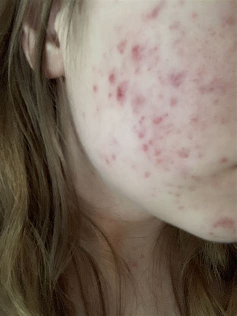 Red Marks Left Over From Acne Any Suggestions Hyperpigmentation