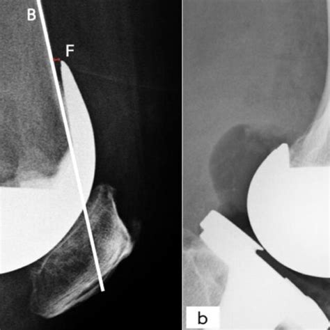 Postoperative Radiographs Of Total Knee Arthroplasty With The Anterior