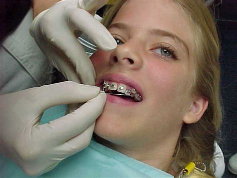 Six Tips For Cleaning Your Teeth With Braces Jacksonville University School Of Orthodontics