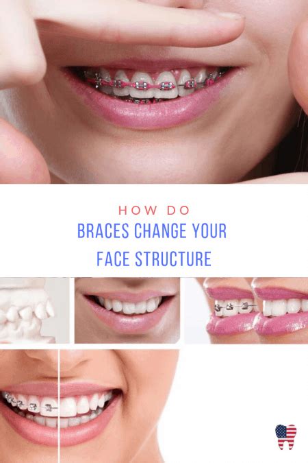 How Do Braces Change Your Face Structure Best Orthodontist Usa