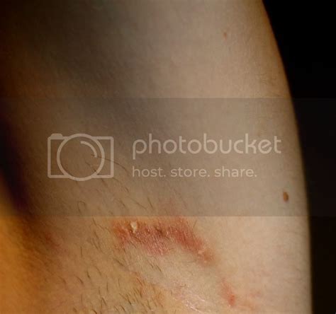 Embarrassing Underarm Problem Rash Fungus Skin Ask Metafilter