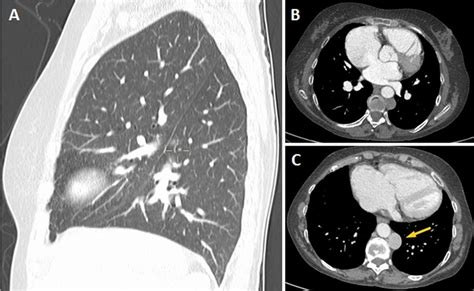 Chest Ct Scan With Intravenous Contrast A Sagittal Mpr Reconstruction