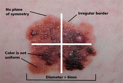 Mole Vs Melanoma Knowing The Difference Could Save Lives