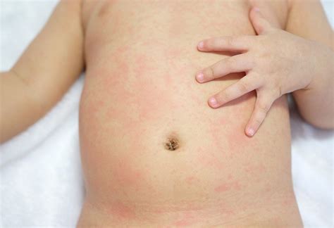 Heat Rash On Baby Causes And Treatment Bellybelly Riset
