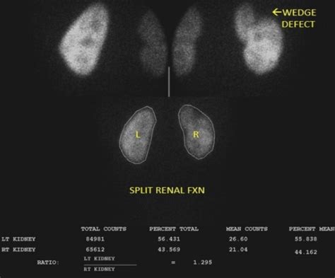 Renal Scintigraphy What Is It Good For Renal Fellow Network
