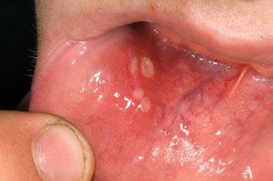 Case Study Recurrent Mouth Ulcers GPonline