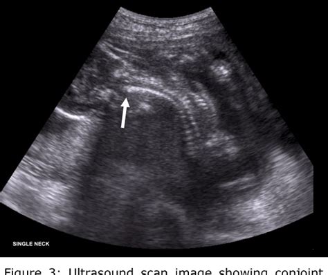 Figure 3 From Prenatal Ultrasound Diagnosis Of