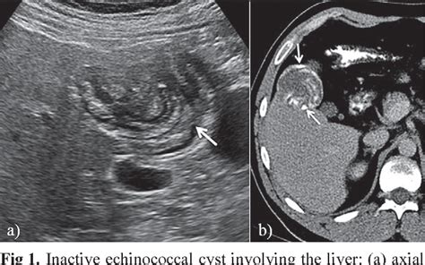 Figure 1 From A Rare Retrovesical Hydatid Cyst And Value Of Transrectal