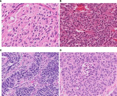 Frontiers Molecular Pathology Of Pulmonary Large Cell Neuroendocrine