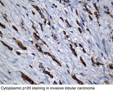 Pathology Outlines Invasive Lobular Carcinoma