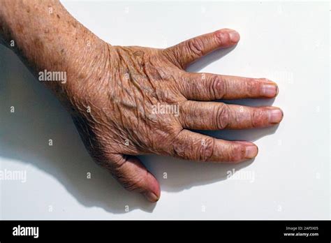 The Process Of Aging Of Human Skin Wrinkled Hands Of A Very Old Man