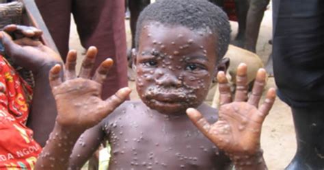 1 day ago · monkeypox is an infectious disease caused by the monkeypox virus that can occur in certain animals including humans. Monkey Pox - Causes, Symptoms, Treatment, Diagnosis and ...