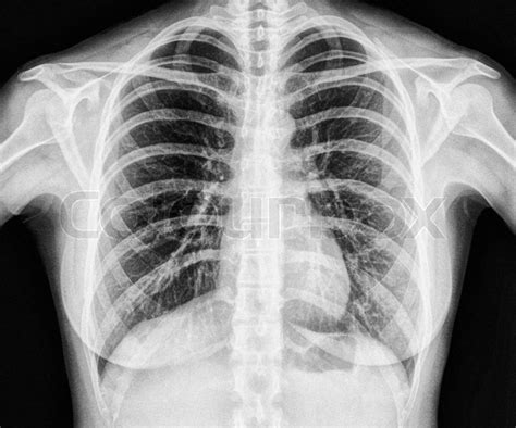 X Ray Image Of Human Healthy Chest Mri Stock Image Colourbox