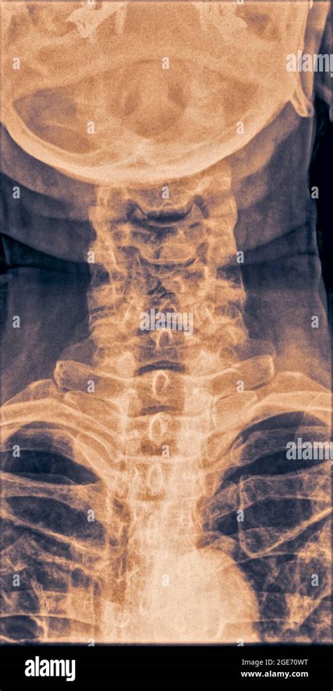 Normal Cervical Spine X Ray Of A 70 Year Old Female Patient Front View