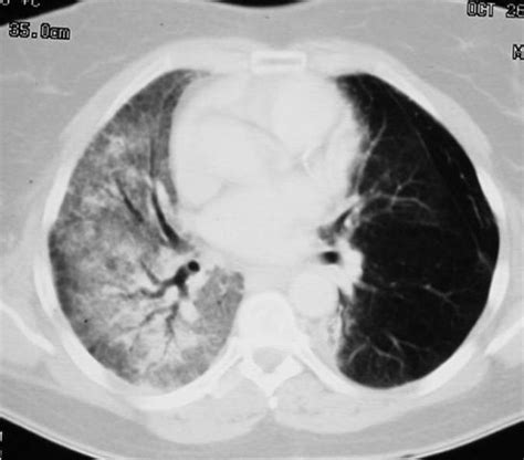 Learningradiology Radiation Fibrosis Pneumonitis