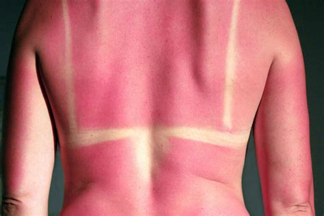 The Guide To Heat Illness And Sunburns Keeping Yourself Protected