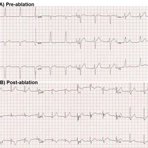 Twelve Lead Electrocardiogram A Pre Ablation A Short Pr Interval And